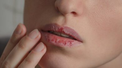 علاقة جفاف الشفاه بـ نقص الفيتامينات والمعادن