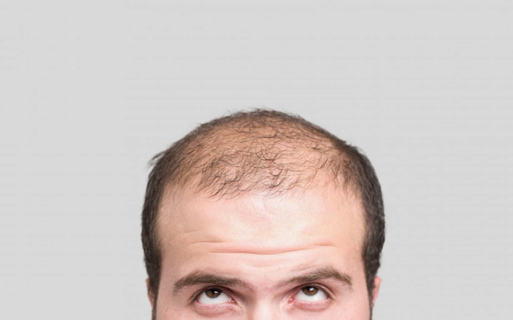 ما الذي ينبغي توقعه بخصوص تساقط شعر الرجل؟
